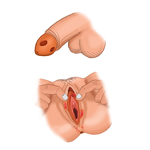 Одна или несколько (обычно безболезненных) круглых маленьких язвочек (шанкры), которые обычно располагаются на половых органах, включая рот, анус или влагалище